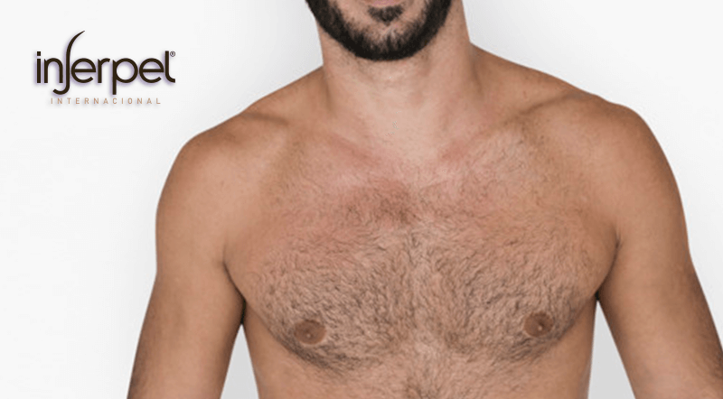 body hair transplant